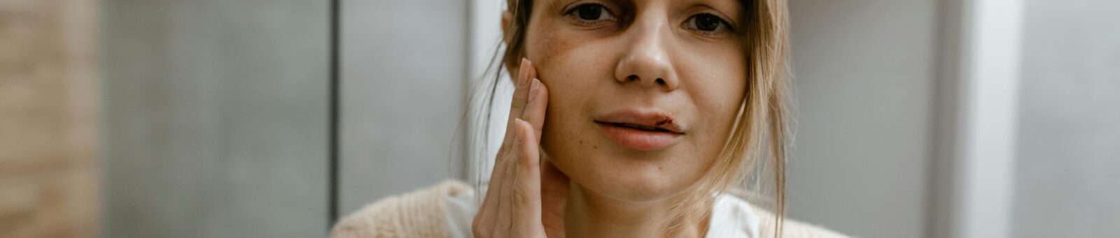A woman looking sad touching her bruised face